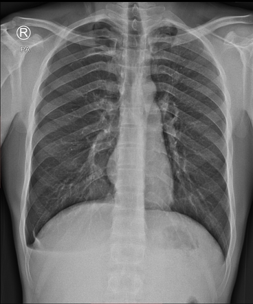 Spontaneous pneumothorax | Radiology Case | Radiopaedia.org