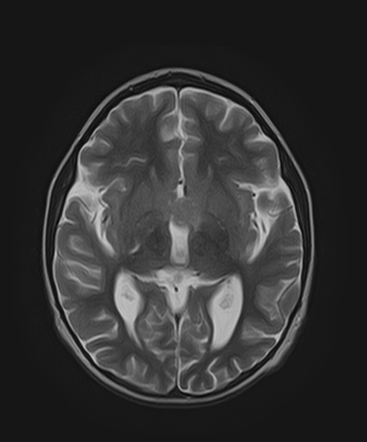 Acute lymphoblastic leukemia with optic pathway involvement | Image ...