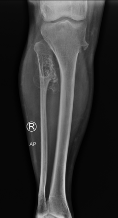 Diaphyseal aclasia | Radiology Case | Radiopaedia.org