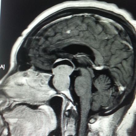 Pituitary macroadenoma | Image | Radiopaedia.org