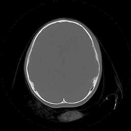 High riding jugular bulb | Image | Radiopaedia.org