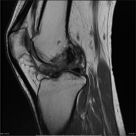 Cyclops lesion (knee) | Radiology Reference Article | Radiopaedia.org