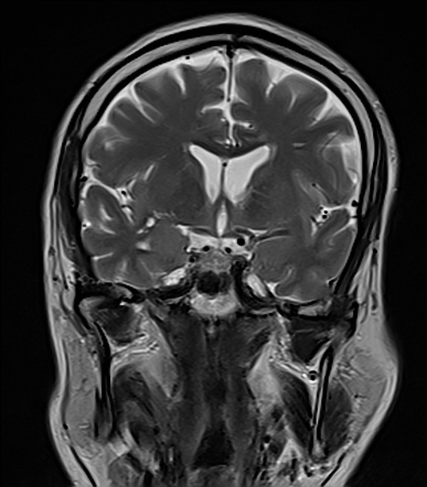 Orbital cavernous hemangioma | Image | Radiopaedia.org