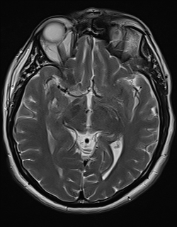 Orbital cavernous hemangioma | Image | Radiopaedia.org