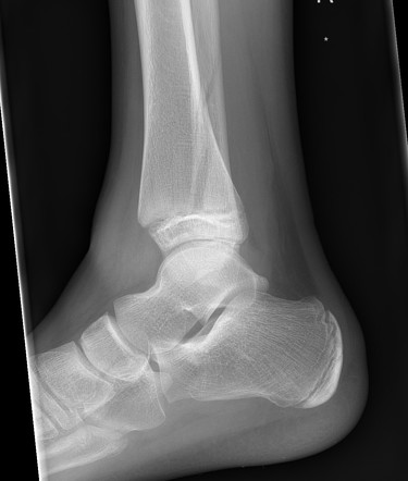 Salter-Harris II tibia | Image | Radiopaedia.org