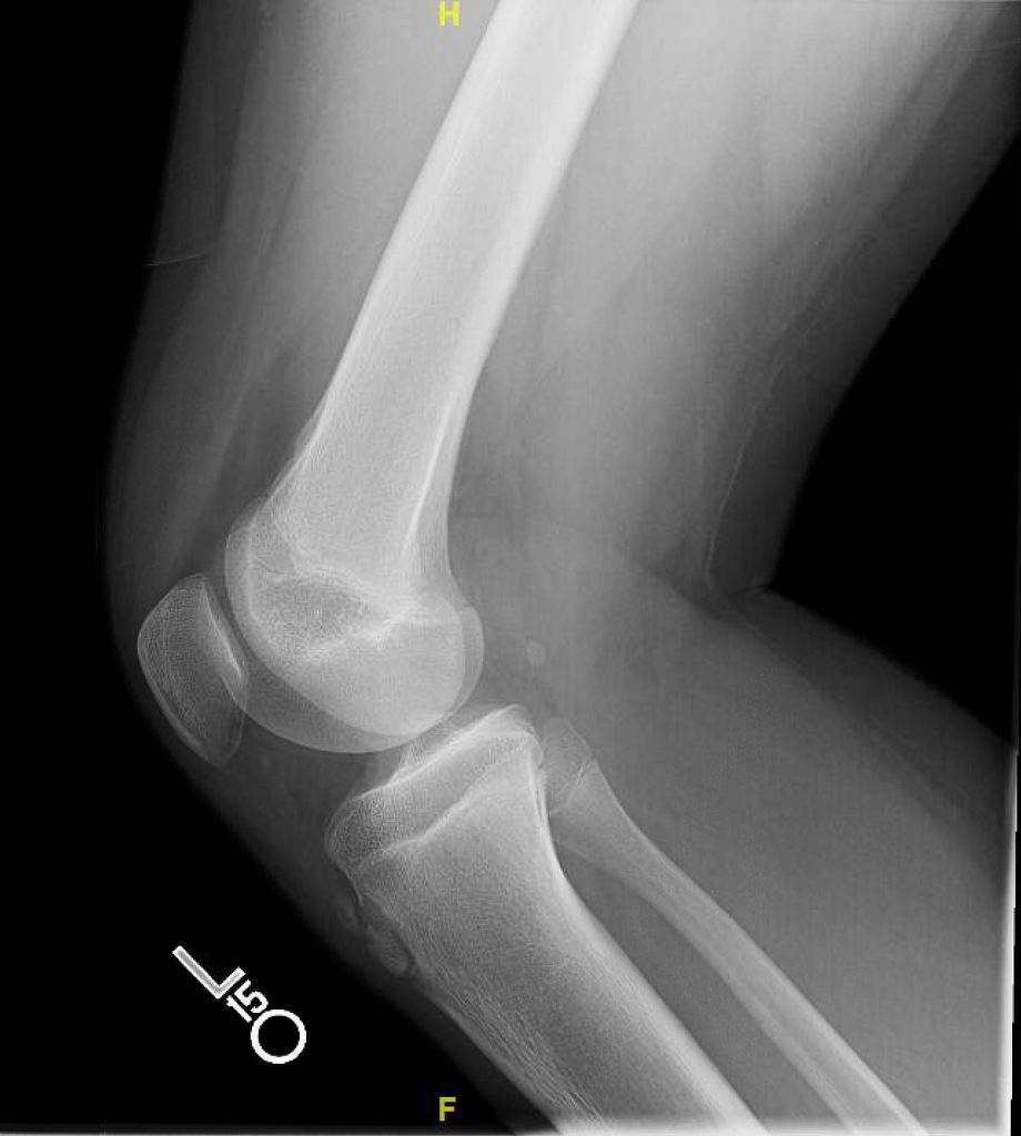 Osgood Schlatter Disease X Ray - Captions Quotes