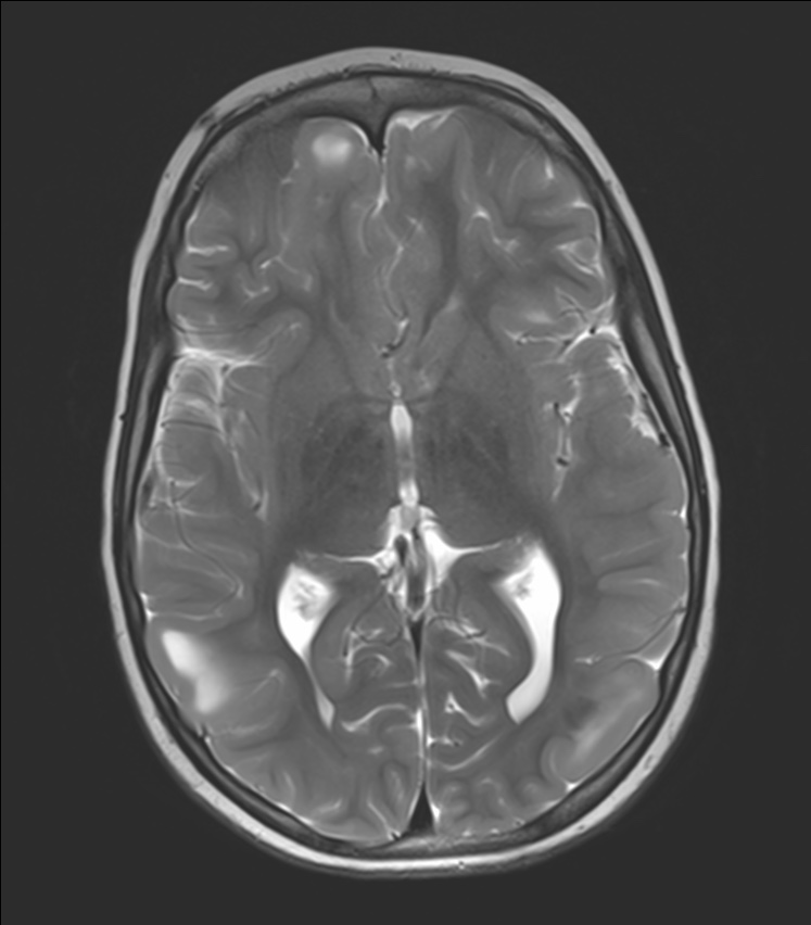 Tuberous sclerosis | Image | Radiopaedia.org