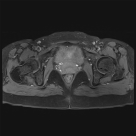 Unicornuate uterus | Image | Radiopaedia.org