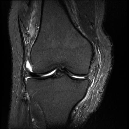 Bucket handle tear of medial meniscus | Image | Radiopaedia.org