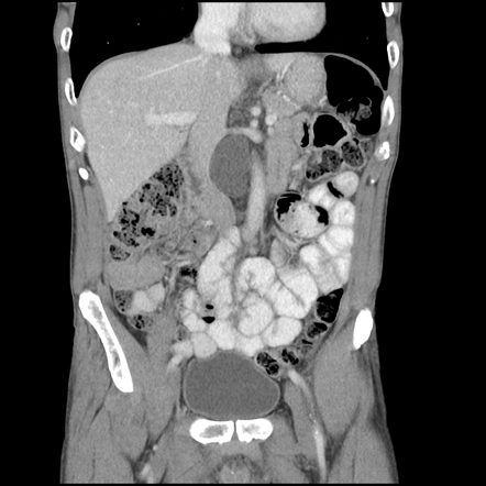 Enlarged cisterna chyli | Image | Radiopaedia.org