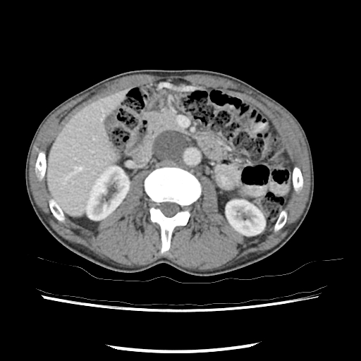 Enlarged cisterna chyli | Image | Radiopaedia.org