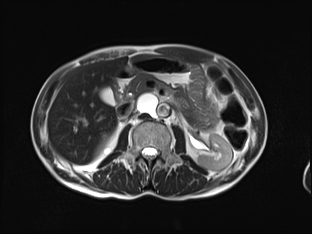 Enlarged cisterna chyli | Image | Radiopaedia.org