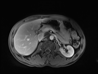 Enlarged cisterna chyli | Image | Radiopaedia.org