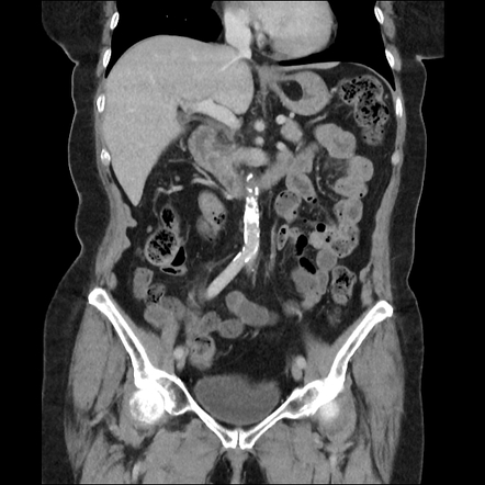 Gastric lipoma | Radiology Case | Radiopaedia.org