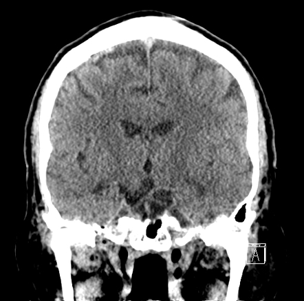 Ischemic stroke - dense posterior cerebral artery (PCA) sign | Image ...