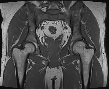 Femoroacetabular impingement - mixed-type | Image | Radiopaedia.org