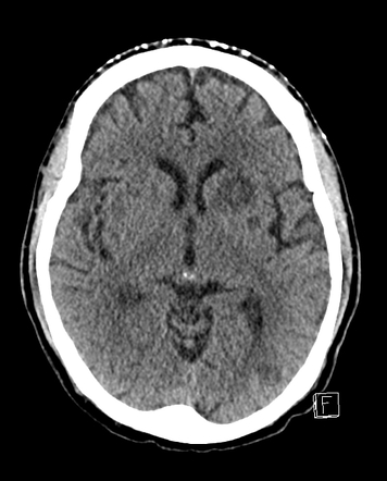 CNS cryptococcosis | Image | Radiopaedia.org