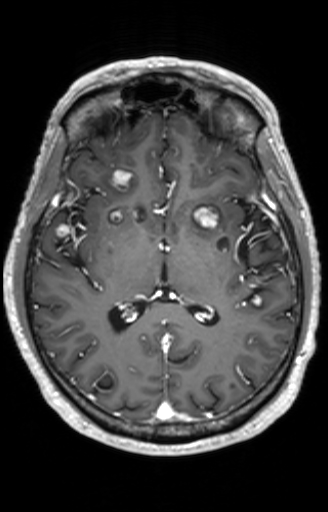 Cns Cryptococcosis Image