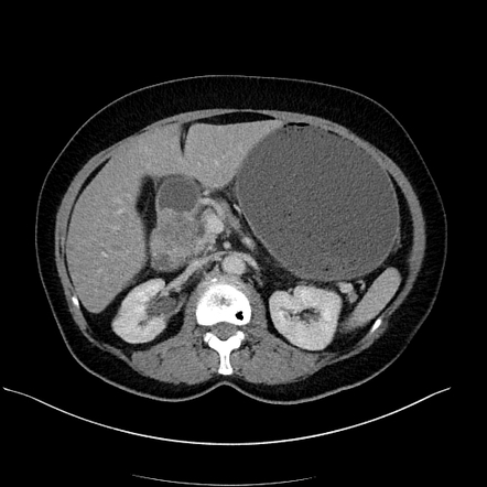 Duodenal adenocarcinoma | Radiology Reference Article | Radiopaedia.org