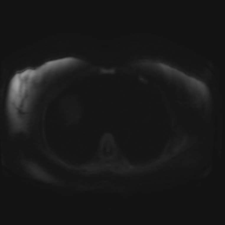 Adrenal cortical carcinoma | Image | Radiopaedia.org