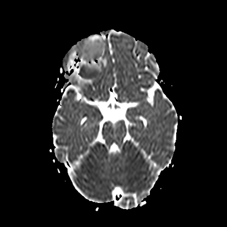 Intracranial epidural abscess | Image | Radiopaedia.org