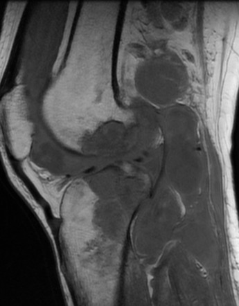 Tuberculosis - knee | Radiology Case | Radiopaedia.org