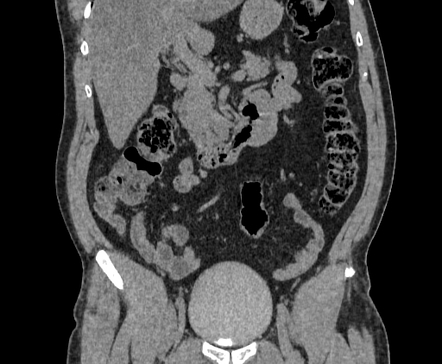 Zinner syndrome | Image | Radiopaedia.org