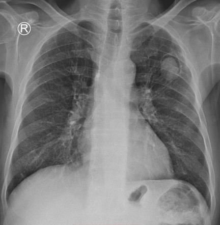 Aspergilloma | Radiology Case | Radiopaedia.org