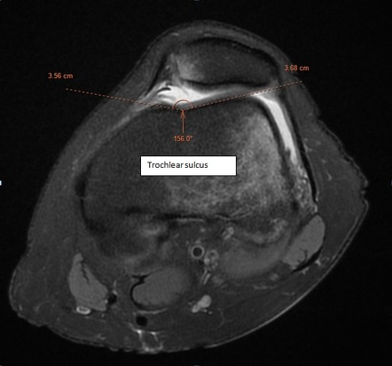 Trochlear dysplasia with transient lateral patellar dislocation | Image ...