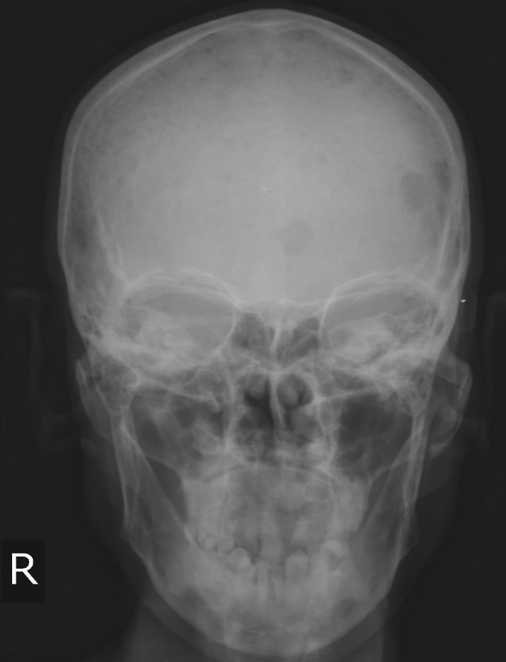 Multiple Myeloma Image Radiopaedia Org