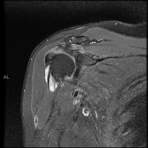 Intratendinous ganglion cyst of long head biceps Image