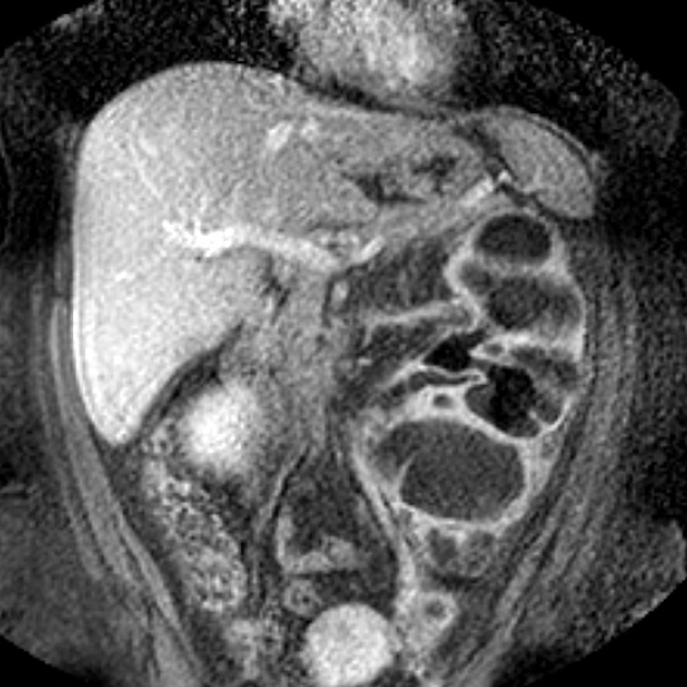 Xanthogranulomatous Pyelonephritis | Radiology Reference Article ...