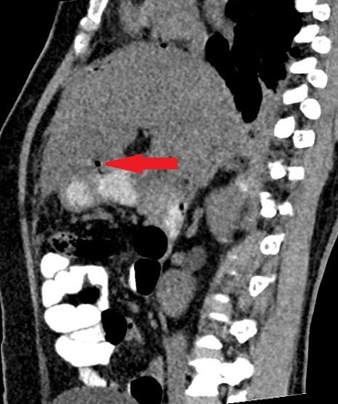 Peptic Ulcer Disease Radiology Reference Article Radiopaedia Org