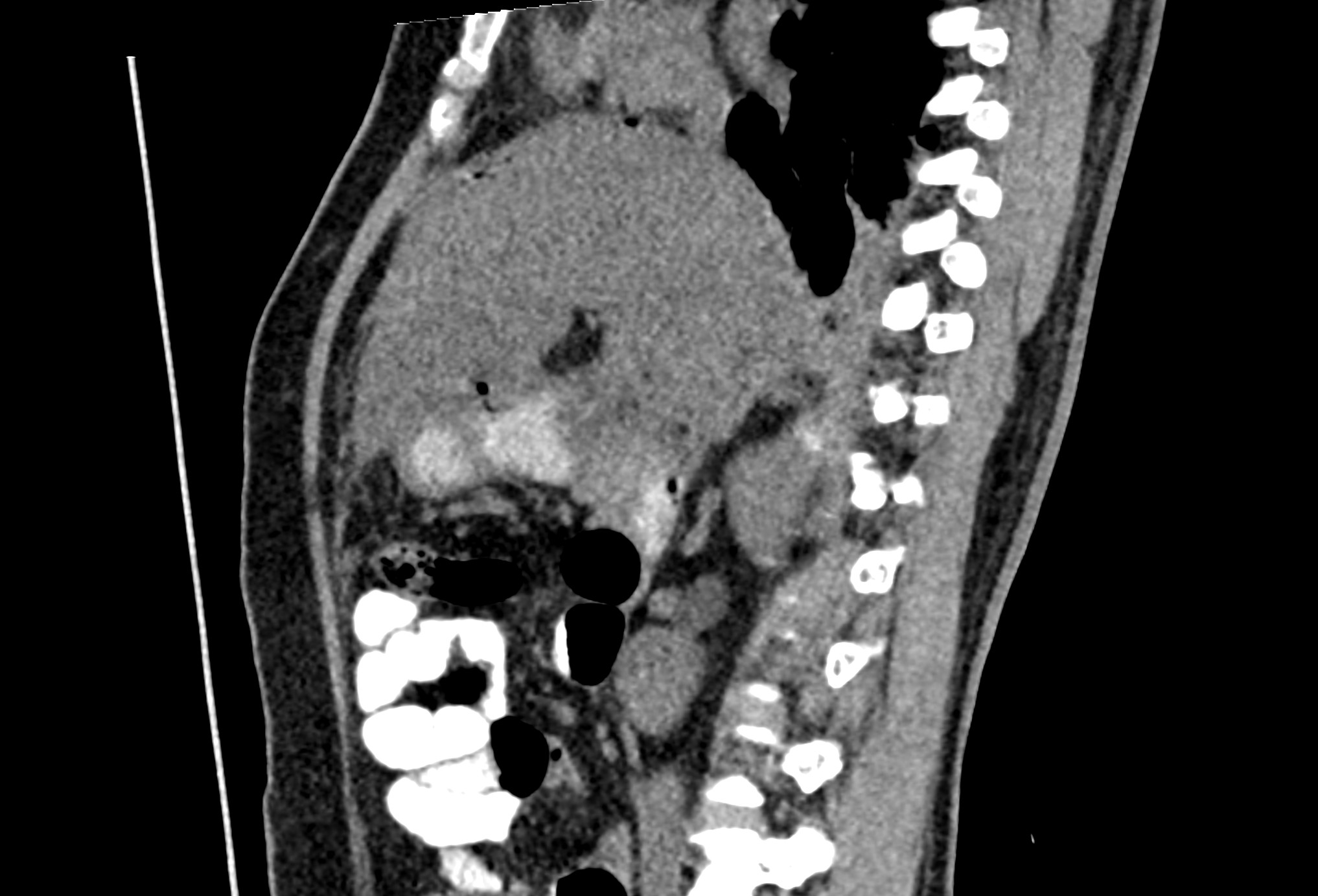 Perforated Duodenal Ulcer Image 