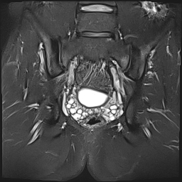 Osteitis condensans ilii | Image | Radiopaedia.org