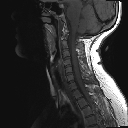 Fracture of spinous processes | Radiology Case | Radiopaedia.org