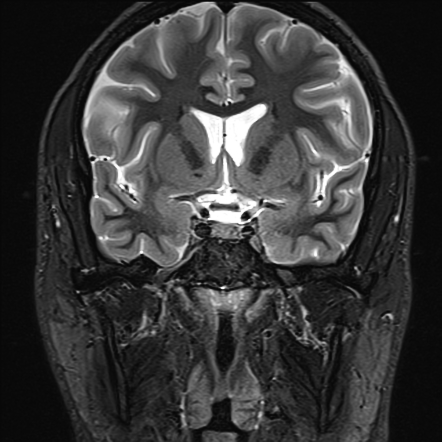 Tolosa-Hunt syndrome | Image | Radiopaedia.org