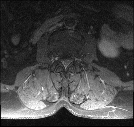 Epidural angiolipoma - lumbar spine | Image | Radiopaedia.org