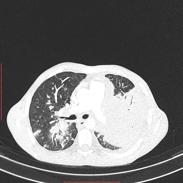 Featured image of post Lobar Pneumonia Lung