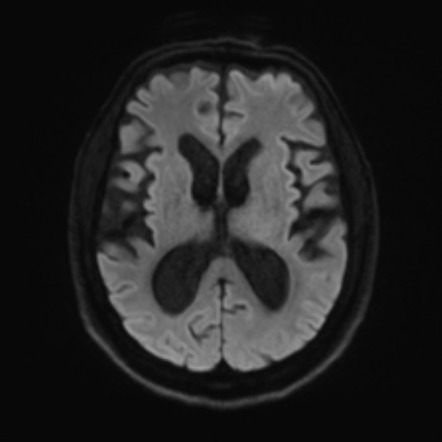 Normal pressure hydrocephalus | Image | Radiopaedia.org