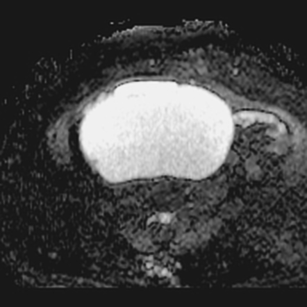 Benign seromucinous cystadenoma of the ovary | Image | Radiopaedia.org