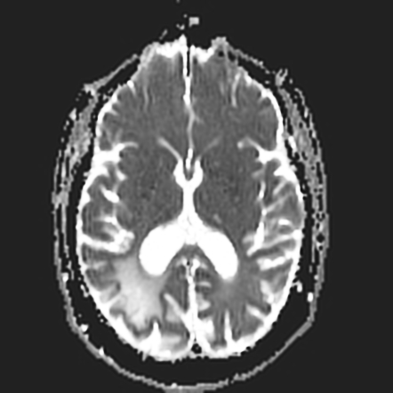 Divry van Bogaert syndrome | Image | Radiopaedia.org