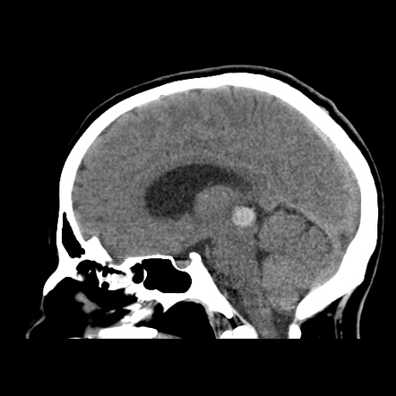 Tectal plate cavernoma | Image | Radiopaedia.org