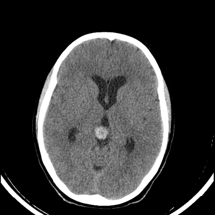 Tectal plate cavernoma | Image | Radiopaedia.org