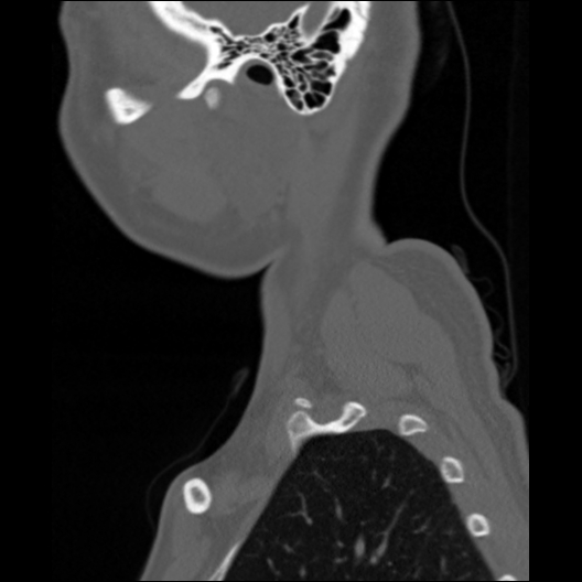 Cervical rib | Image | Radiopaedia.org