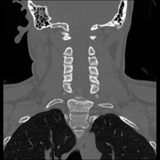 Cervical rib | Image | Radiopaedia.org