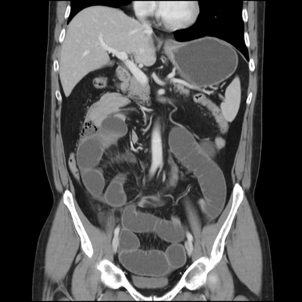 Right anterior paraduodenal hernia with small bowel obstruction | Image ...