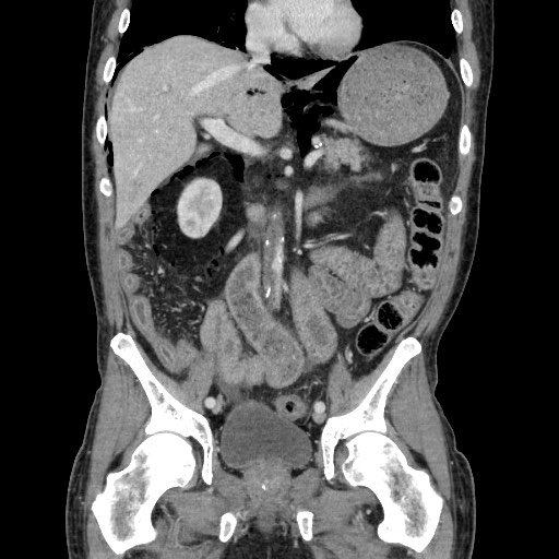 Pneumatosis coli, graft versus host disease, acute aortic thrombus ...