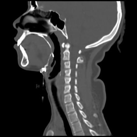 Thyroglossal Duct Fistula | Radiology Case | Radiopaedia.org