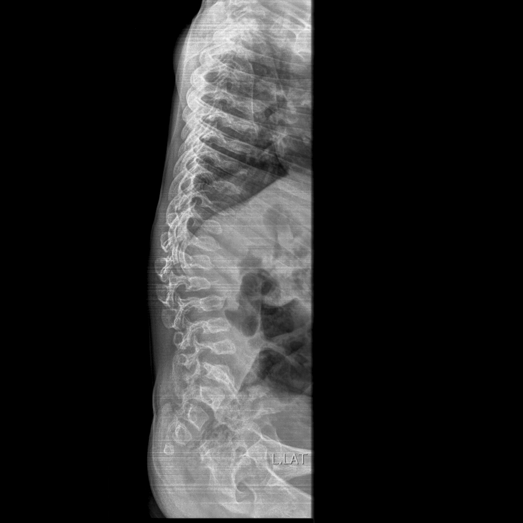 Morquio syndrome | Image | Radiopaedia.org